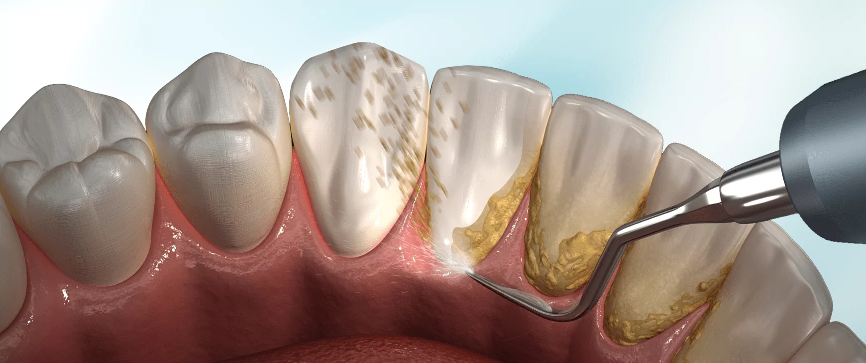 Image d'illustration d'un détartrage classique