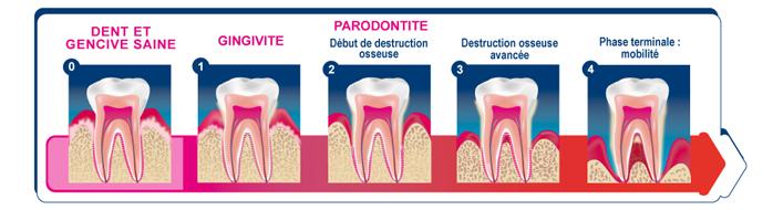 Schéma de l'évolution de la parodontite