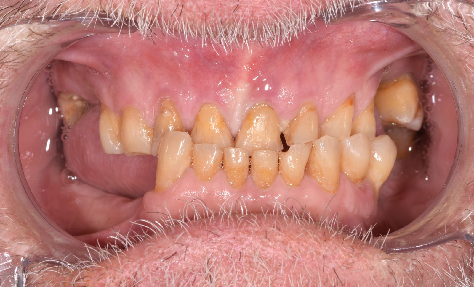 Réhabilitation globale avant