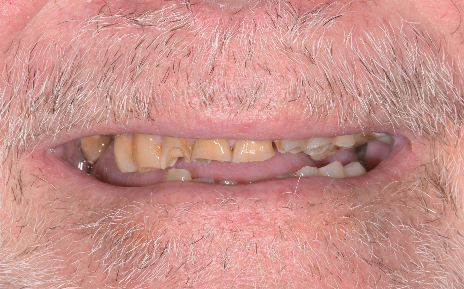 Réhabilitation globale avant