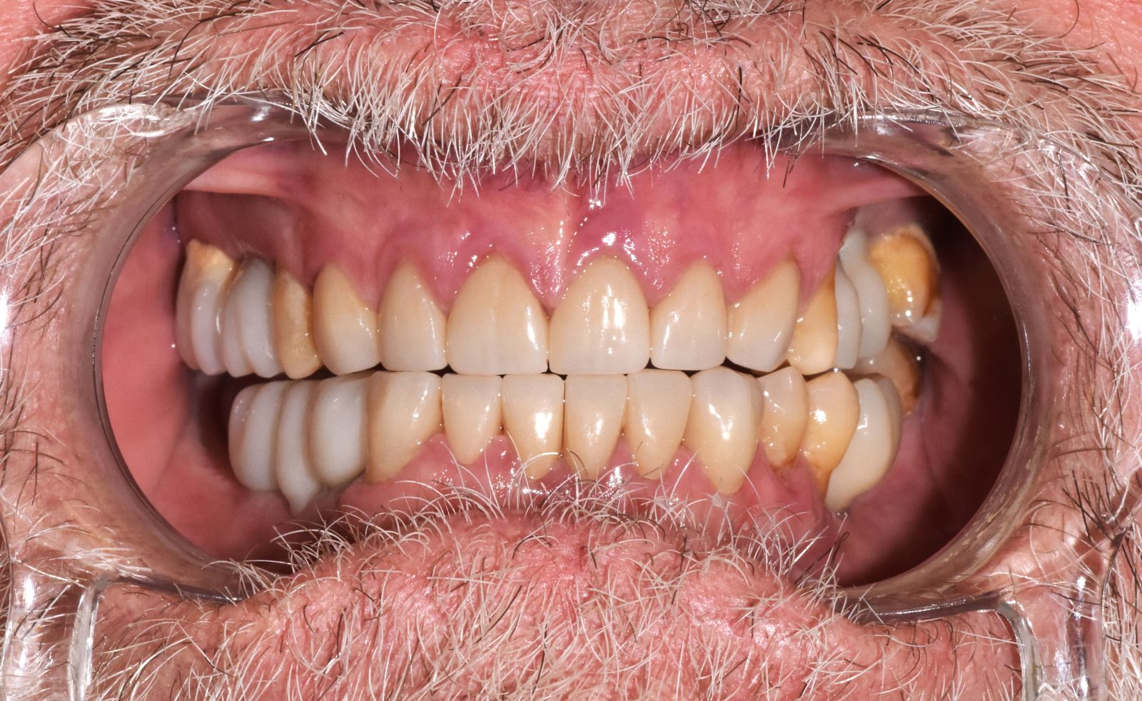 Réhabilitation globale après