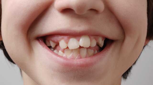 Orthodontie de l'enfant au Cabinet dentaire de Seilh