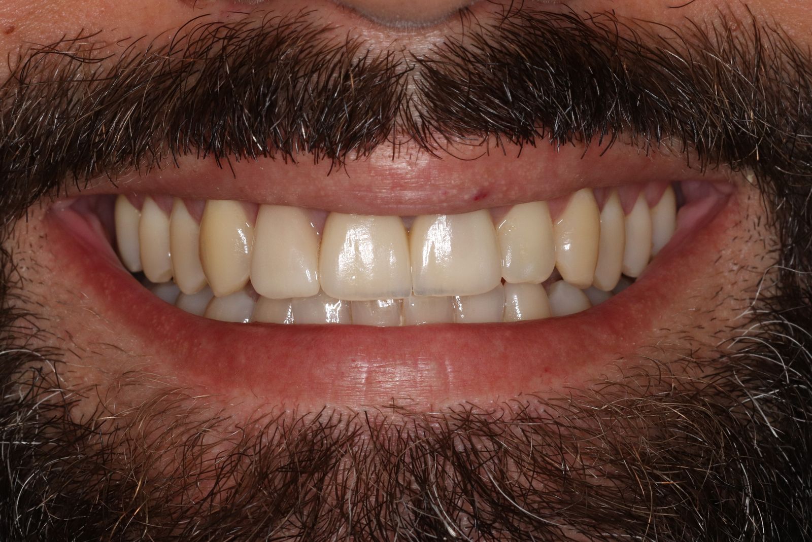 Pose de facettes dentaires au Cabinet Dentaire de Seilh