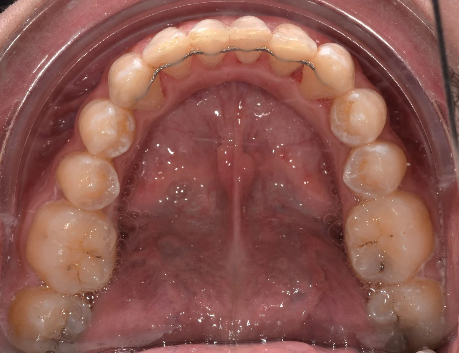 Contentions fixées au cabinet dentaire de Seilh