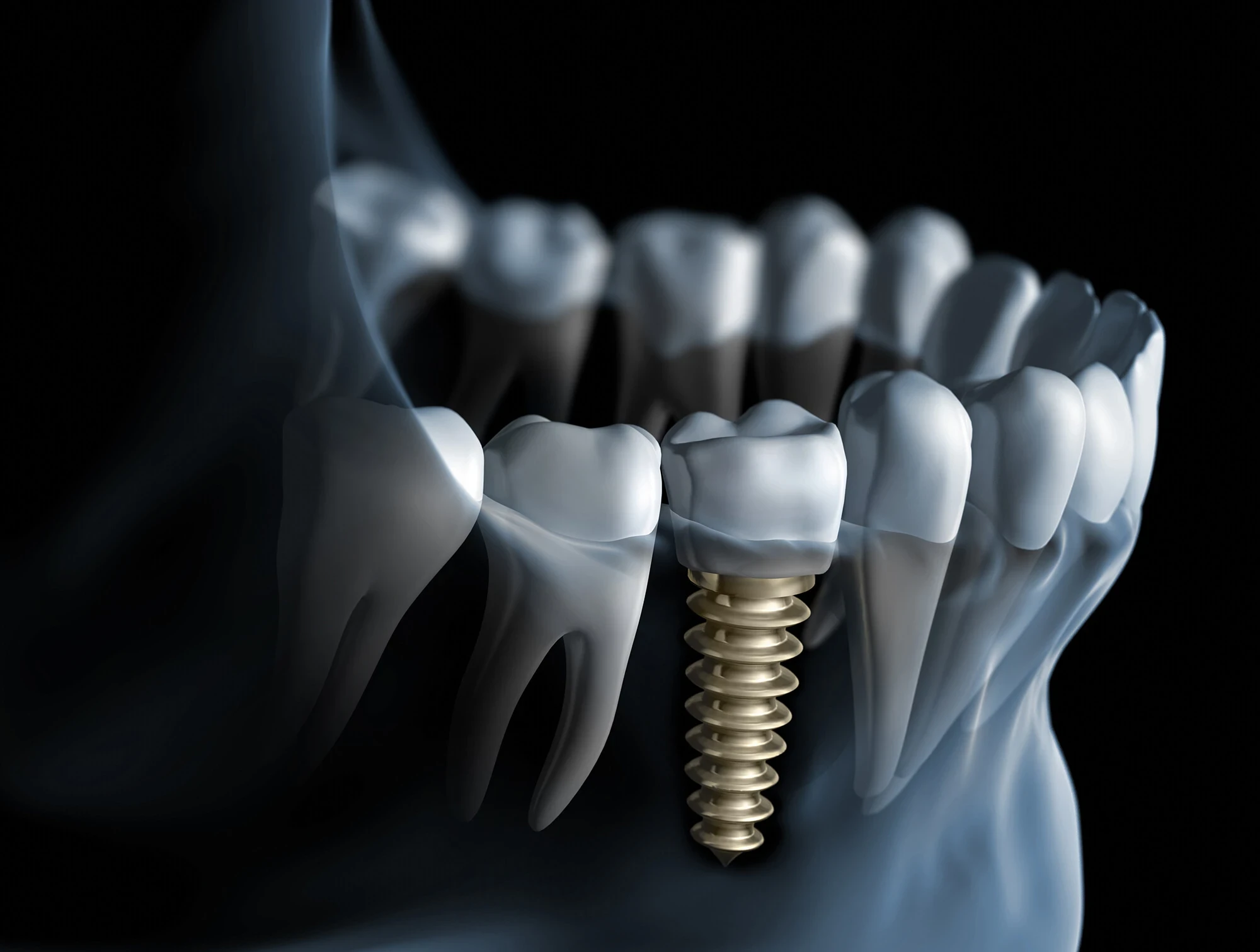Vue 3D d'un implant dentaire