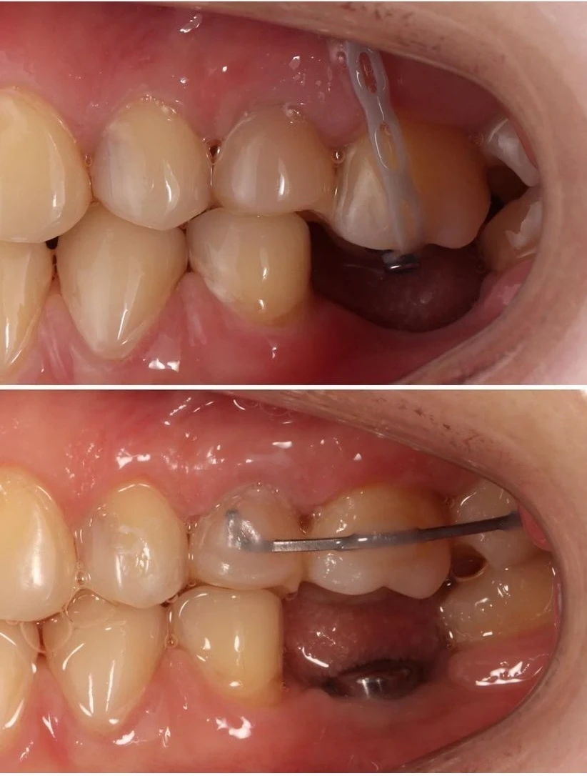 Orthodontie pré-prothétique au cabinet dentaire de Seilh
