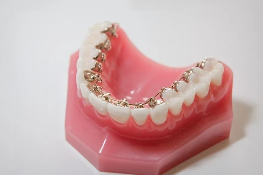 Orthodontie linguale au cabinet dentaire de Seilh