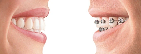 Orthodontie linguale au cabinet dentaire de Seilh