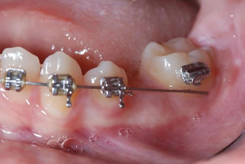 Fil sorti d'un bracket molaire