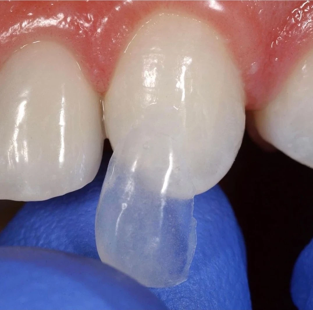 Pose de facettes dentaires au Cabinet Dentaire de Seilh